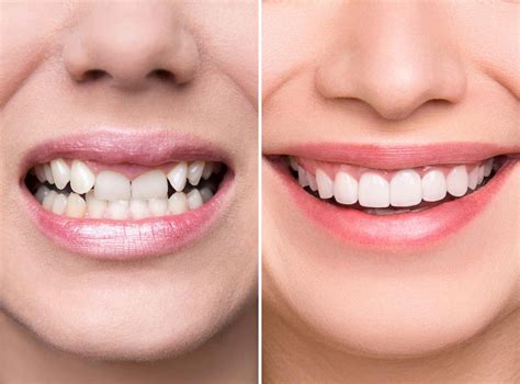 smile direct club bone loss Yes, Smile Direct Club can have a shorter treatment time than Invisalign… but this is largely because it cannot be used for complex cases